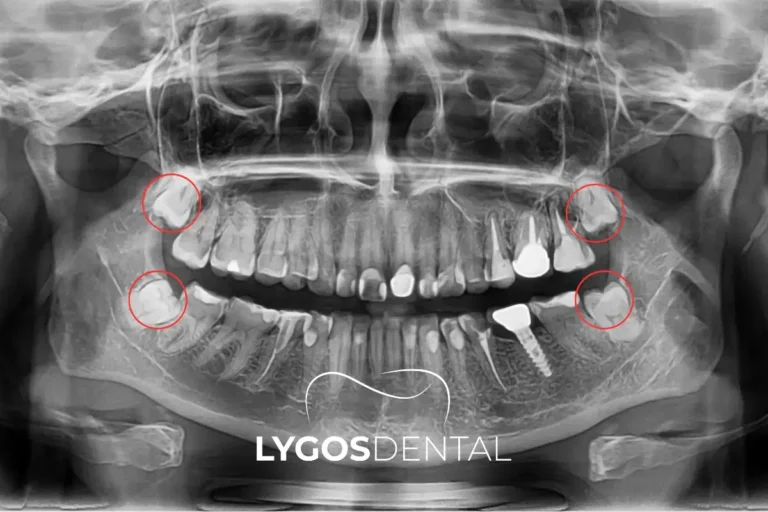 Hangi Diş Çekilmesi En Zor Olandır?