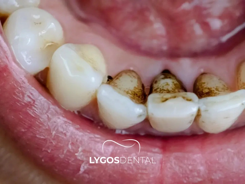 Perché si formano le strisce nere sui denti e come trattarle | LYGOS DENTAL