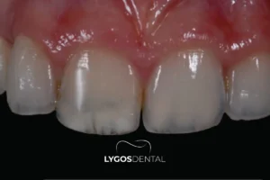 Why Do Teeth Become Transparent and How to Fix It?