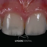 ¿Por qué los dientes se vuelven transparentes y cómo solucionarlo?