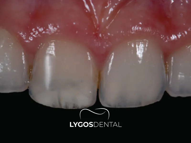Почему зубы становятся прозрачными и как это исправить? | LYGOS DENTAL