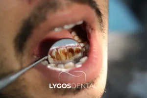 Why Black Lines Form on Teeth and How to Treat Them​ | LYGOS DENTAL