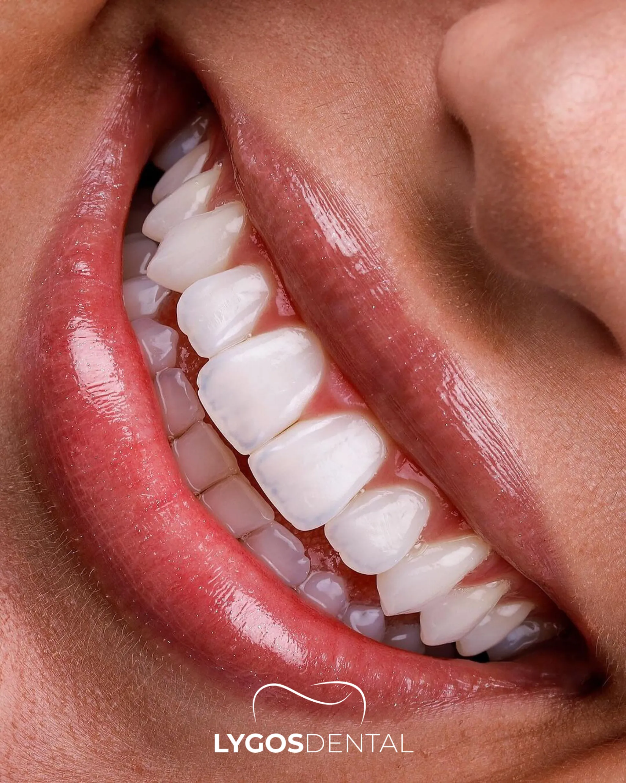Diseño digital de sonrisas | LYGOS DENTAL