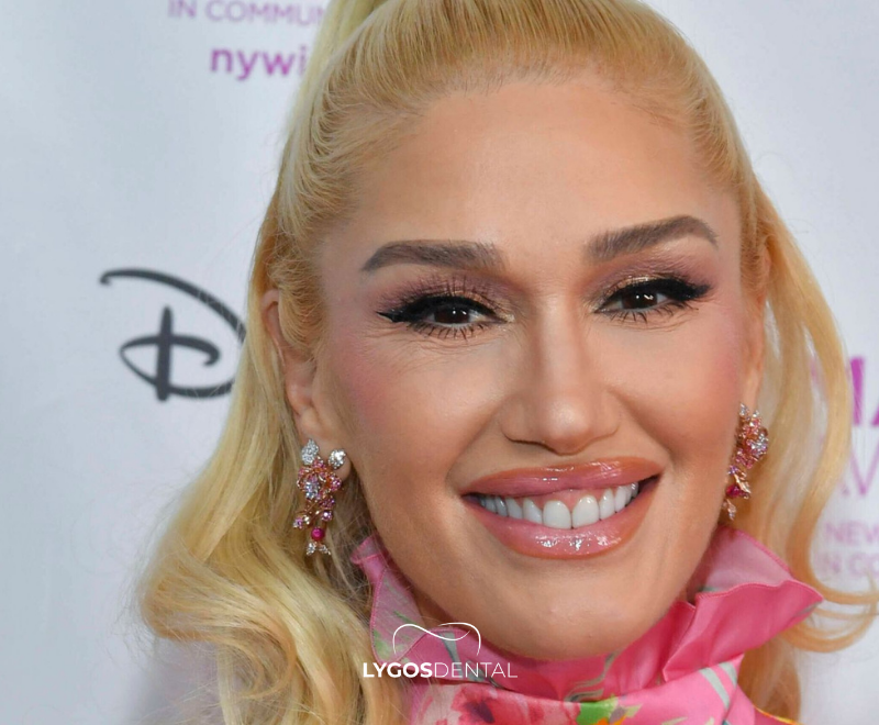 Gwen Stefani tandfacings | LYGOS DENTAL