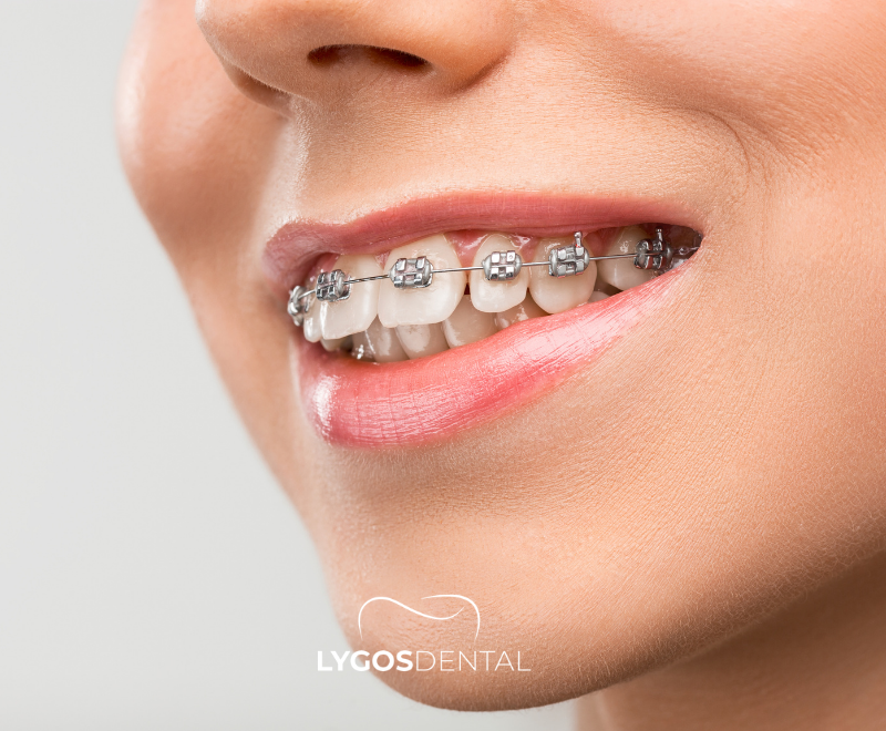 Orthodontics | LYGOS DENTAL