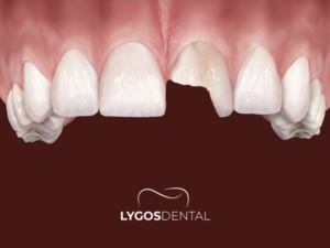 Kırık Diş Tedavisi