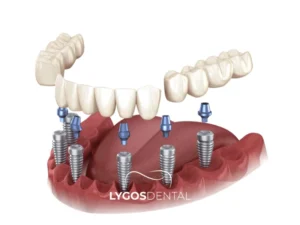 3-on-6 Implant