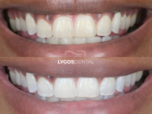 Diş Beyazlatma 1 Diş Beyazlatma