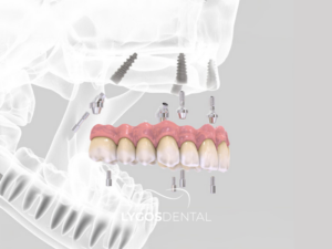 All On Four 2 All On Four