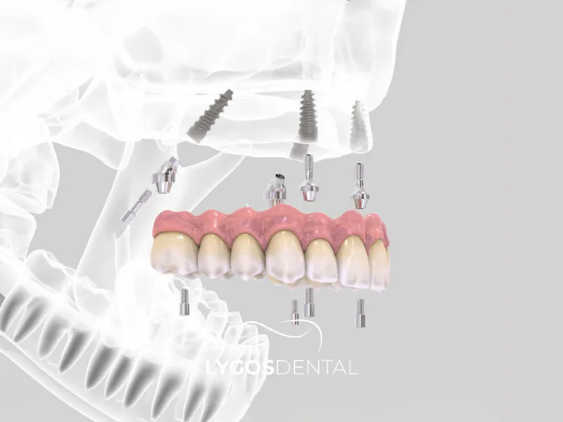 All On Four Nasıl Uygulanır