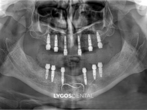 All On Six 3 All On Six