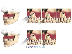 Apikoektomi 3 Apikoektomi