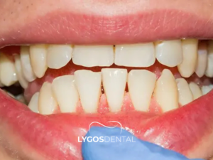 Diş Eti Hastalığı Tedavisi