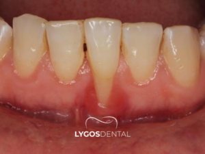 Diş Eti Hastalığı Tedavisi