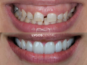 Diş Eti Şekillendirme 2 Diş Eti Şekillendirme