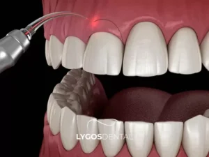Gum Contouring