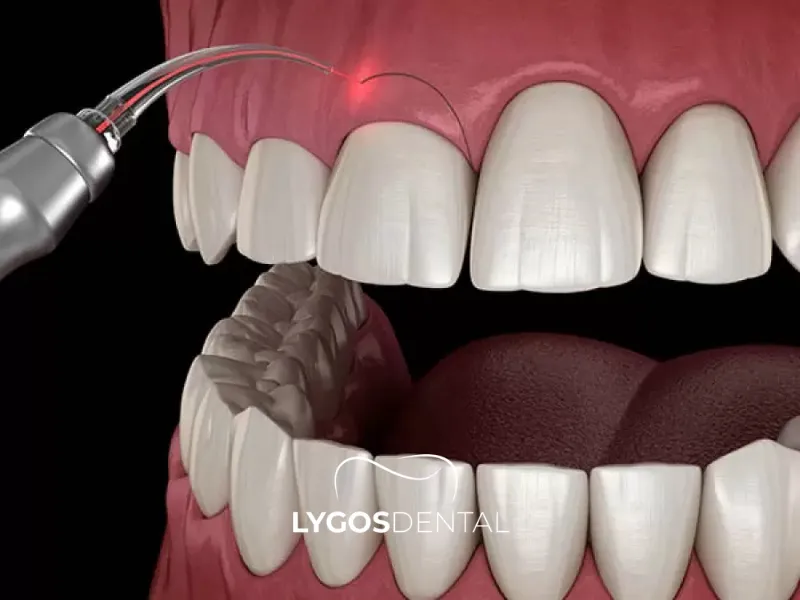 Контурная пластика десен