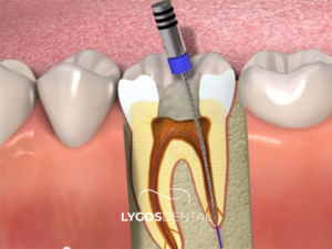 Diş Lezyonu 2 Diş Lezyonu
