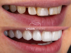 Hollywood Smile 3 Hollywood Smile