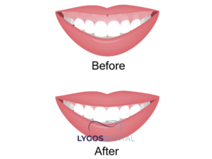 Gummy Smile Tedavisi 3 Gummy Smile Tedavisi