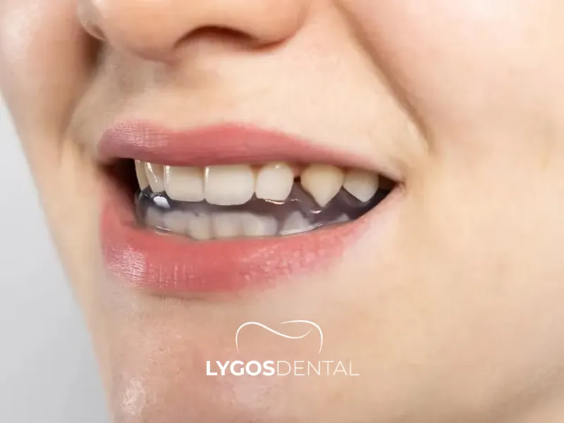 Шина за темпоромандибуларната става