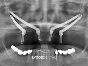 Zigoma İmplant 2 Zigoma İmplant