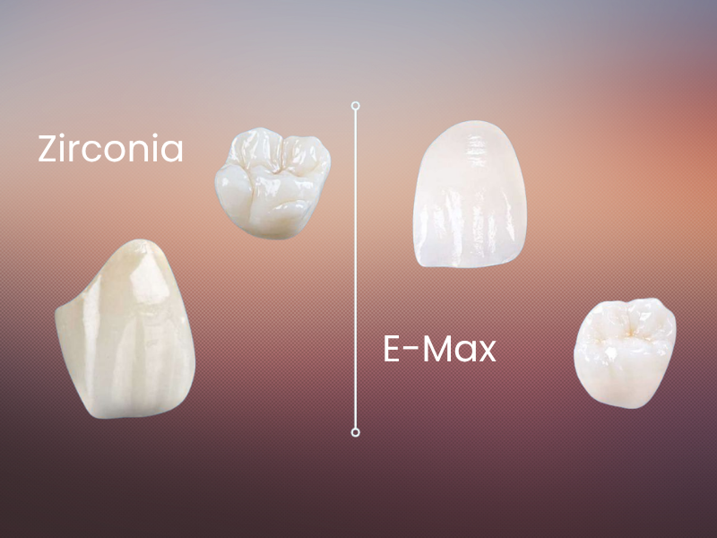 Emax Kaplama ile Zirkonyum Kaplama Arasındaki Fark