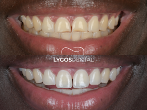 Kırık Diş Tedavisi