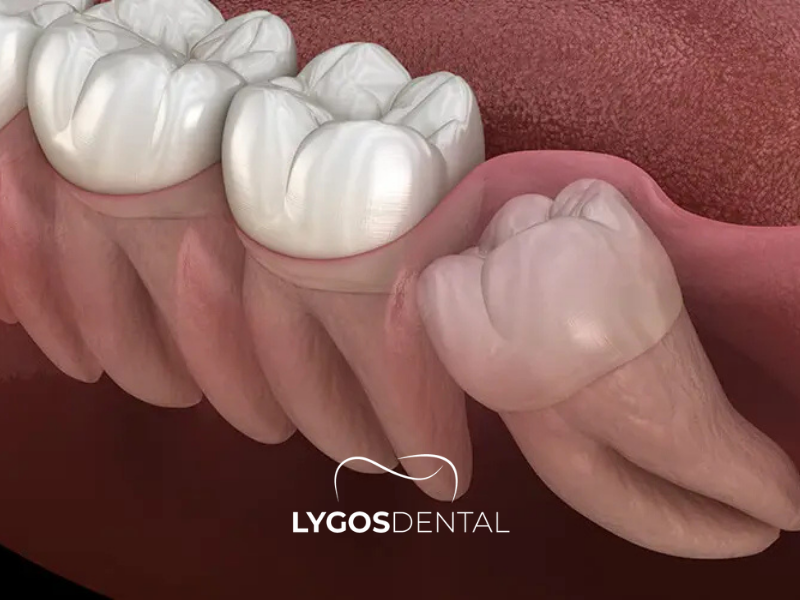 Gömülü Diş Çekimi