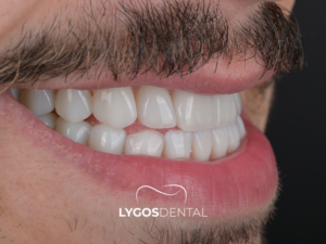 Gülüş Tasarımı 5 Gülüş Tasarımı