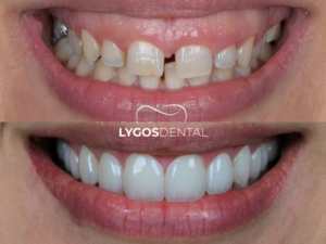 Gülüş Tasarımı 2 Gülüş Tasarımı