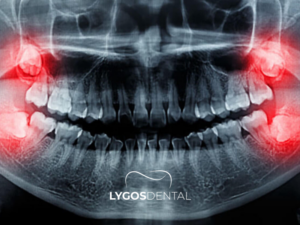 Gömülü Diş Çekimi 3 Gömülü Diş Çekimi