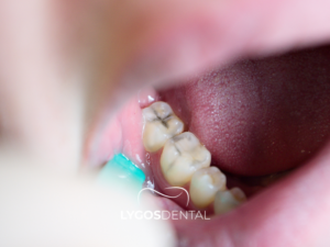 İnley ve Onley Dolgu