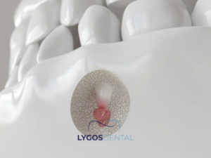 Apikoektomi 2 Apikoektomi