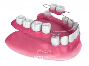 Removable Denture