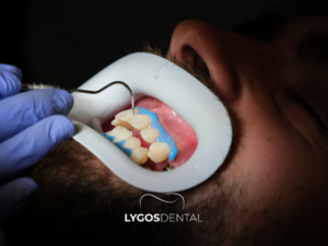 Diş Beyazlatma 3 Diş Beyazlatma