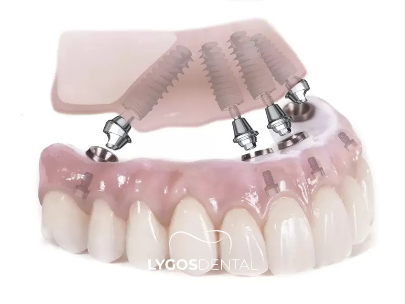 İleri Derecede Kemik Erimesi Olanlar İçin Uygun Mu