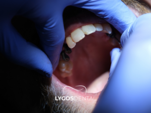 Diş İmplantı 2 Diş İmplantı