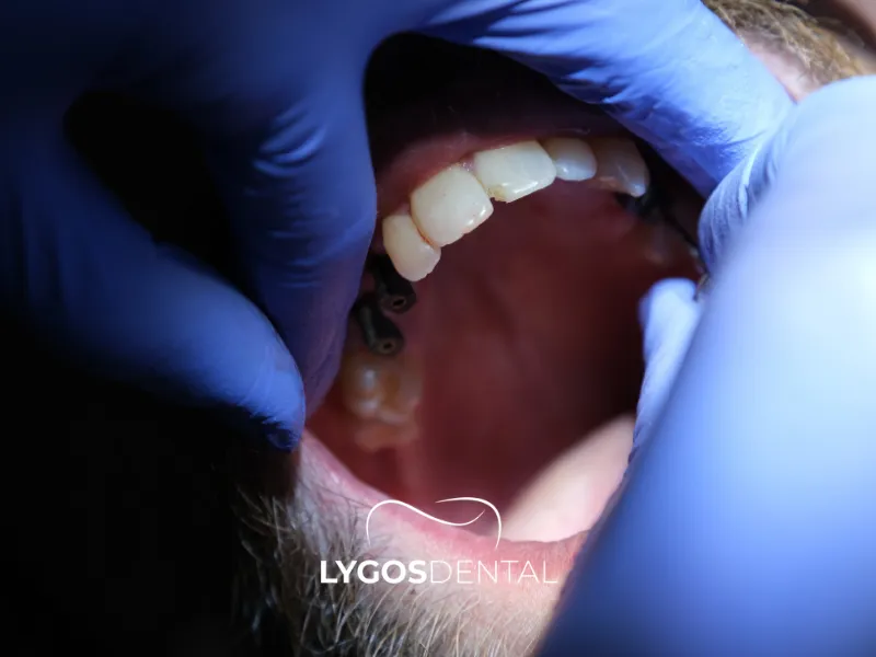 Implant Tedavisi Nasil Yapilir