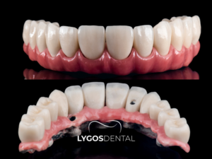 İmplant Üstü Protez 3 İmplant Üstü Protez