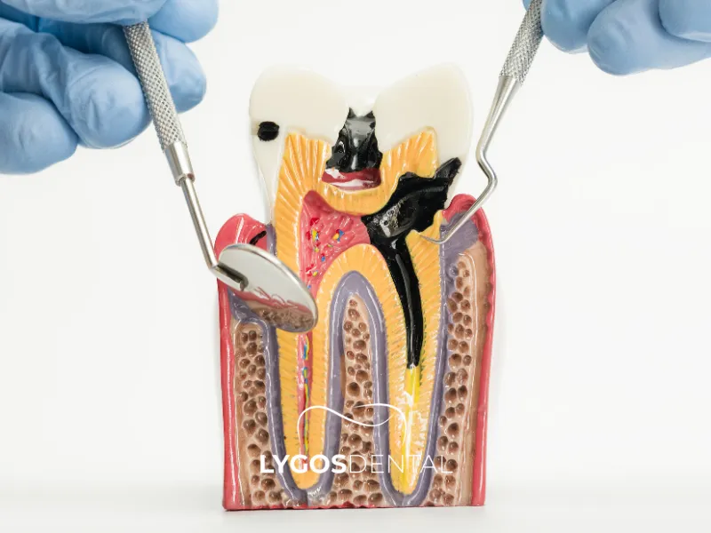 Kanal Tedavisi Hangi Durumlarda Gerekir