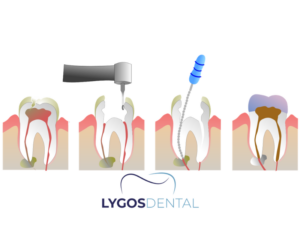 Kanal Tedavisi 2 Kanal Tedavisi