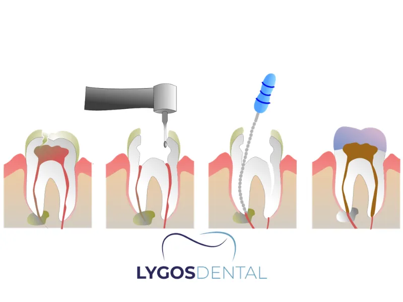 Kanal Tedavisi Nasıl Yapılır