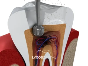 Root Canal Treatment