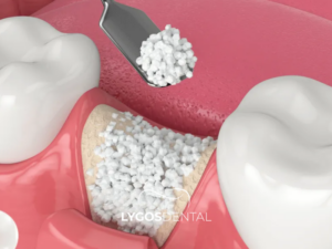 Diş İmplantı 3 Diş İmplantı