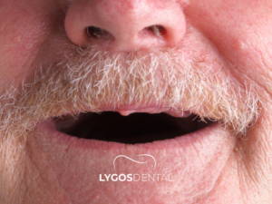 İmplant Üstü Protez 2 İmplant Üstü Protez