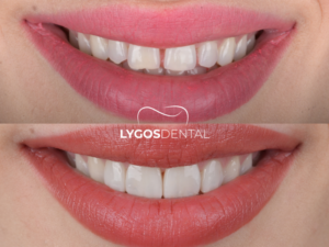 Kompozit Bonding 3 Kompozit Bonding