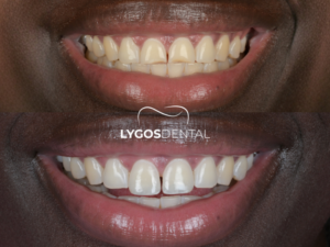 Kompozit Bonding 2 Kompozit Bonding