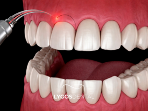 Gummy Smile Tedavisi 2 Gummy Smile Tedavisi