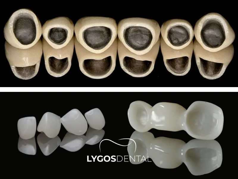 Metal Destekli Porselenler ile Zirkonyum Arasındaki Farklar